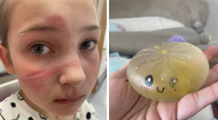 Menina de 10 anos queima rosto após fazer trend do TikTok com brinquedo