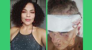 Mulher sobrevive a tentativa de feminicídio e mobiliza campanha para recomeçar a vida