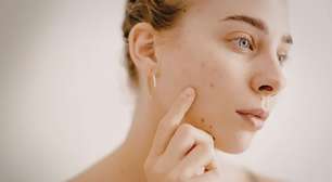 O fim da acne? Ciência testa vacina para combater a inflamação da pele; saiba tudo