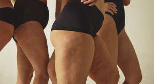 Quando sei que é lipedema ou celulite? Entenda as diferenças
