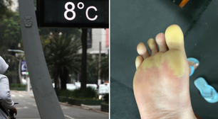 Saí de casa de chinelo nesse frio e meus dedos ficaram assim. Esse especialista explica o que aconteceu
