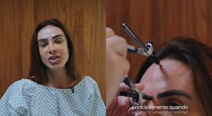 Com quadro de alopecia, Nicole Bahls realiza transplante capilar