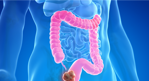 O rastreamento do câncer colorretal mudou no Brasil: SUS adotou um novo teste caseiro que antecipa o diagnóstico do câncer de intestino com tecnologia super sensível ao sangue invisível
