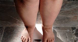 Obesidade eleva risco de doenças do coração