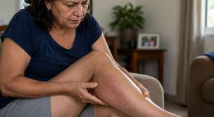 Nem toda trombose começa de forma grave e isso faz muita gente ignorar os sinais