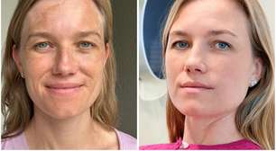 Melasma controlado: empresária surpreende com antes e depois