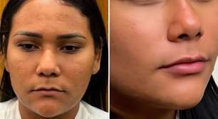 Ex-BBB Chaiany mostra resultado de harmonização facial e web avalia: 'Outra pessoa'