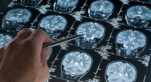 Doença de Alzheimer poderia ser causada por disputa entre proteínas