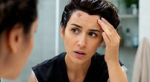 Tingiu o cabelo e manchou a pele? Veja como remover sem sofrimento