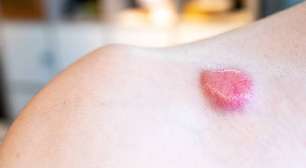 Prevenção ao Câncer de Pele Não Melanoma: Alertas e Cuidados
