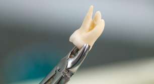 Dente do siso: por que temos e quando é necessário tirar?