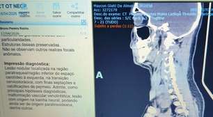 Cirurgia remoção de tumor no pescoço: a corrida contra o tempo