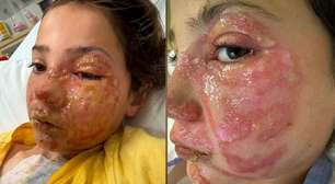 Menina de 10 anos sofre queimaduras graves no rosto após reproduzir desafio viral de rede social
