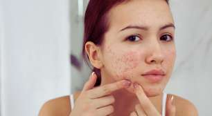 Mês da Acne reforça importância de cuidados e informações sobre a condição