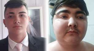 Tumor com menos de 1 centímetro fez adolescente ganhar 40 quilos em 6 meses