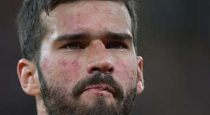 O que Alisson tem no rosto? Doença crônica sem cura afeta pele do goleiro do Brasil na Copa 2026; médico explica diagnóstico e aponta cuidado especial: 'Protetor solar'