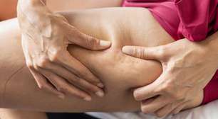 Anticoncepcional causa celulite? Especialistas explicam polêmica