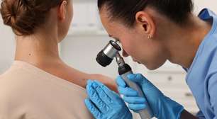 Entenda os sinais de alerta em pintas para prevenir o melanoma