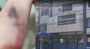 Pai presta queixa contra escola de Santos após filho com TEA cortar braço e levar 13 pontos