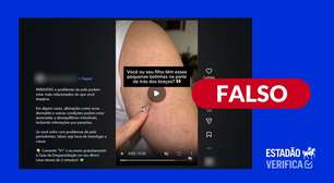É falso que 'bolinhas' na pele de crianças sejam sintoma de parasitas intestinais