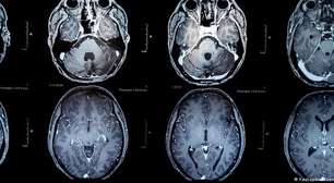 Vacina é a nova esperança contra tumores cerebrais