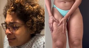 Atriz da Globo mostra antes e depois da perna após cirurgia para remover gordura: 'Só sabia chorar'