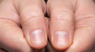 Como a falta de vitaminas afeta sua pele e unhas