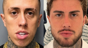 MC Daniel impressiona com antes e depois após procedimentos estéticos: 'outro CPF'