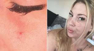 Ela conviveu anos com uma "espinha" no rosto até descobrir o que realmente era