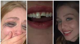 Jovem quebra dente em balada, vai ao dentista de madrugada e volta para a festa; vídeo viraliza