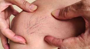 Saúde vascular: cuidados essenciais para quem passou dos 40