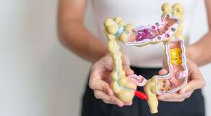 Mais de 90% dos casos de câncer de intestino podem ser curados com diagnóstico precoce