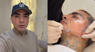 MC Guimê mostra resultado de manutenção da harmonização facial; veja o antes e depois