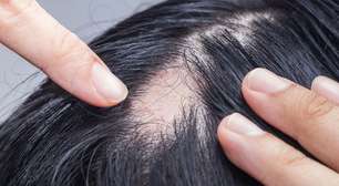 O que é alopecia? Conheça os tipos, causas e tratamentos para a queda de cabelo
