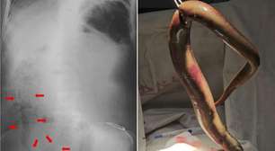 Homem é internado em estado grave após enguia entrar pelo reto e perfurar intestino