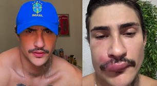 Influenciador Ken de CG é hospitalizado com infecção após espremer espinha na boca