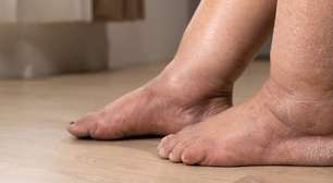 Lipedema: por que o diagnóstico ainda demora