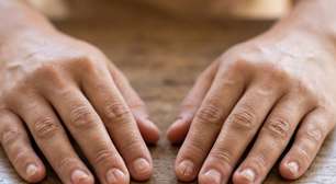Síndrome da unha-patela: unhas pequenas ou deformadas podem indicar doença rara