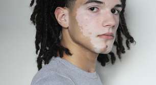 De vendedor de água no farol a modelo: jovem com vitiligo assina com agência de Alessandra Ambrósio