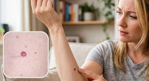 Apareceu uma pinta vermelha do nada? Saiba o que observar