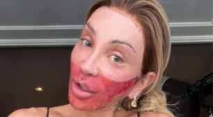 Maya Massafera volta a aparecer com o rosto queimado e explica