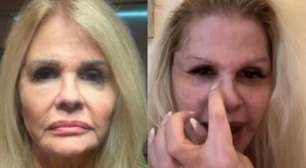 Monique Evans mostra resultado uma semana após rejuvenescimento facial: 'Novo rosto'