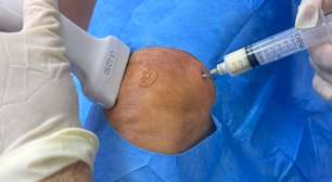 Tratamento com PRP, eficaz para aliviar a dor da artrose, passa a ser regulamentado no Brasil