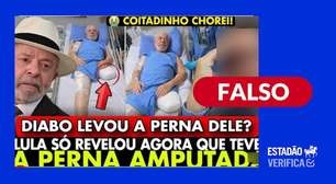 Lula não teve uma perna amputada; postagem com alegação falsa usa imagens manipuladas