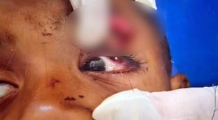 Menino de 6 anos atingido em tiroteio no RJ perde a visão do olho esquerdo