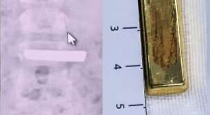 Menina de 5 anos engole barra de ouro avaliada em R$ 37 mil e vai parar na emergência