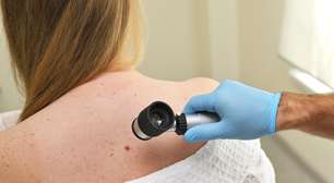Terapia combinada mantém uma redução de 49% no melanoma após 5 anos