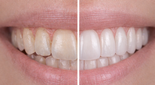 Dentes mais brancos sem agredir o esmalte: o creme dental alemão que reinventou o clareamento