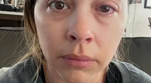 Mulher descobre doença ocular causada por maquiagem