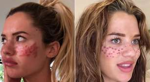 Tatuar sardas vira trend, mas causa infecção e riscos graves